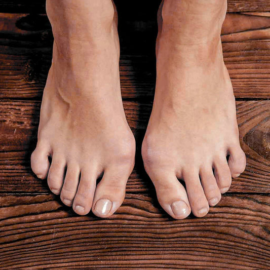 Does Wearing Barefoot Footwear Help with Bunions?